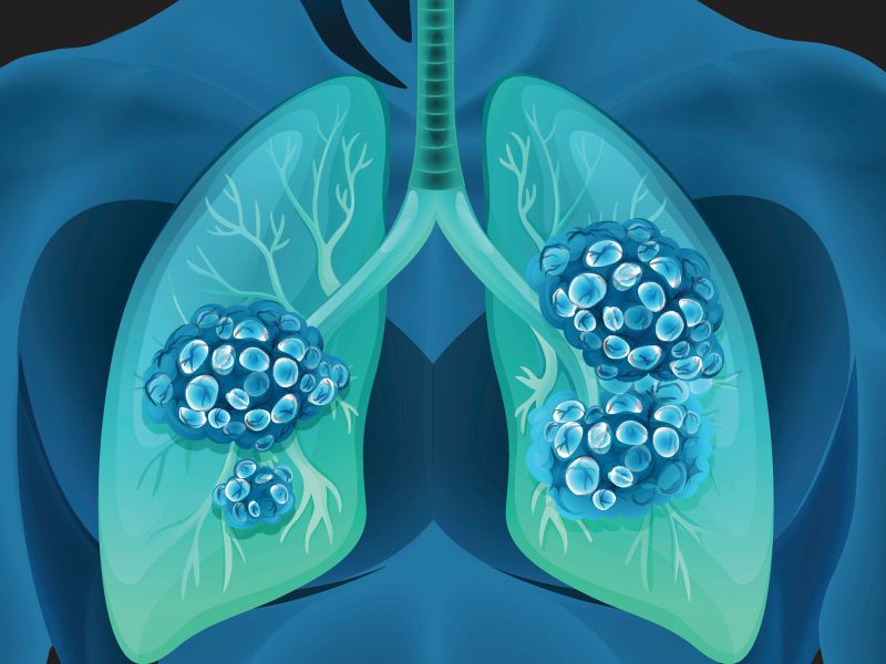 Lung cancer concept